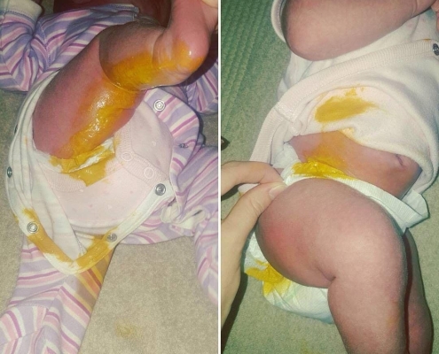 Breastfed baby poo